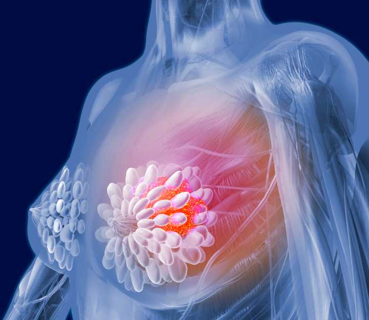Whole Genome Sequencing Adds Significant Prognostic Value in Breast Cancer