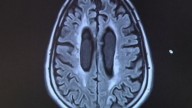 Proposition 14 could create new dementia research institute in Texas