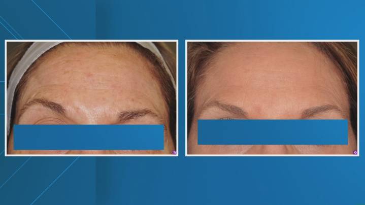 'Risk of having true catastrophe' | Louisiana health officials warn against counterfeit Botox, unlicensed injectors