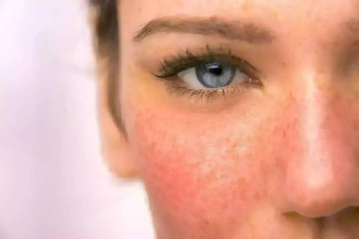 taVNS Shows Promise as New Treatment for erythematotelangiectatic rosacea: JAMA