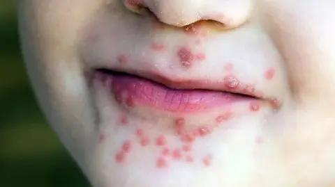 ¡Alarma sanitaria en Oaxaca: el virus Coxsackie explota con un aumento del 335% en menos de tres semanas!