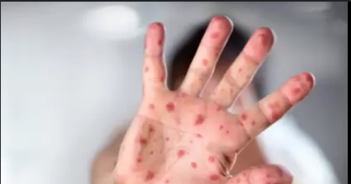 Brote de virus Coxsackie en Quintana Roo enciende alerta epidemiológica