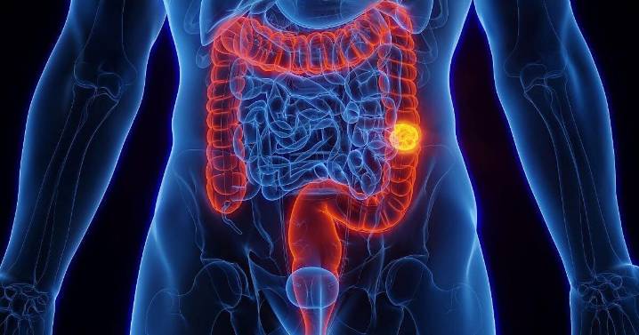 Bleeding Tied To Colon Cancer Risk Among Young Adults