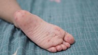Detectan tres casos de virus Coxsackie en escuelas de Puebla