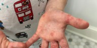 ‘In general, it’s miserable:’ Hand, Foot and Mouth Disease spreading rapidly across Central Virginia