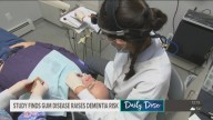 Monday's Daily Dose of Health News with Monica Robins: Study finds gum disease raises dementia risk