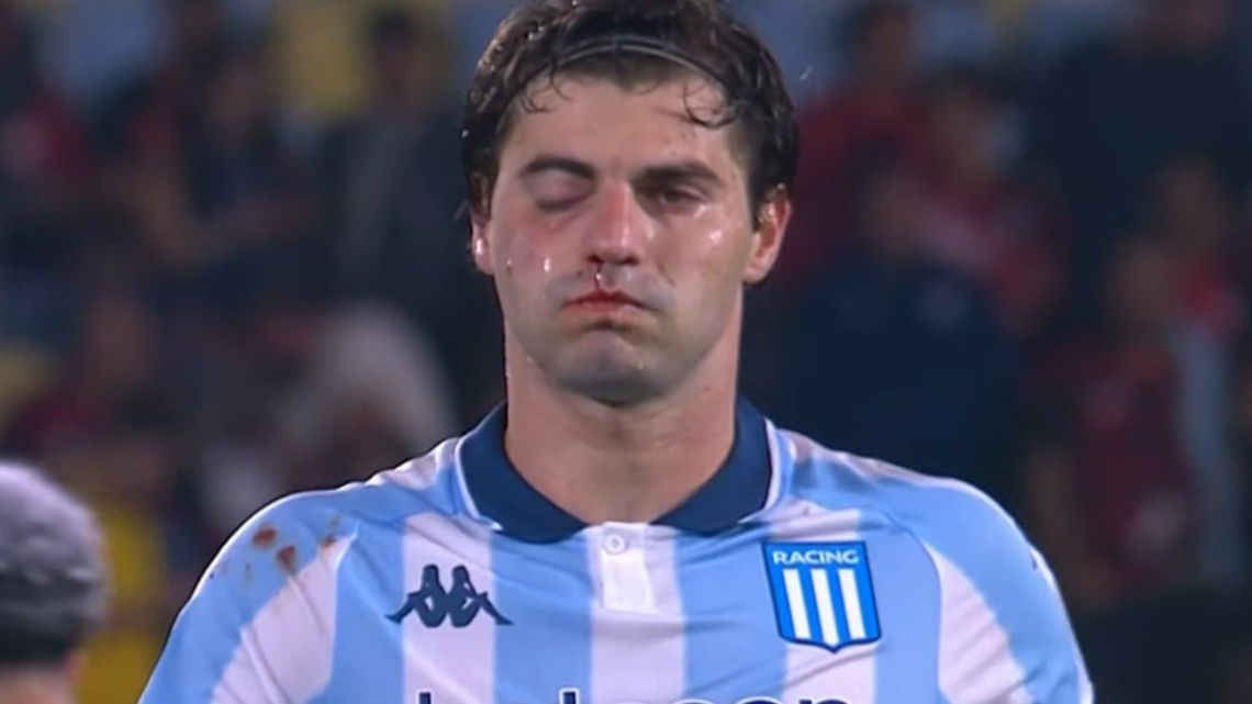 Racing confirmó que Santiago Sosa sufrió una fractura tras un codazo de Marcos Rojo y será operado