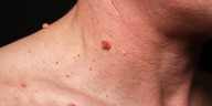 Cómo eliminar las verrugas del cuello de manera segura, rápida y eficaz con este medicamento de venta sin receta