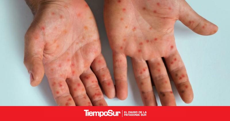 Viruela símica Virna Almeida: “La enfermedad se autolimita y no tiene tratamiento específico”