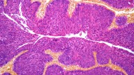 ESMO 2025: ctDNA blood test could change how cancer is treated