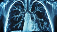 Researchers in China Develop Tool to Detect Hidden Lung Damage in RA Patients
