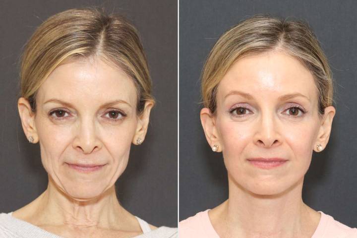 Single Mom Gets Free Facelift with 1,000 Doctors Watching — Before