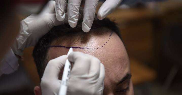 How one country has become a top destination for hair transplants