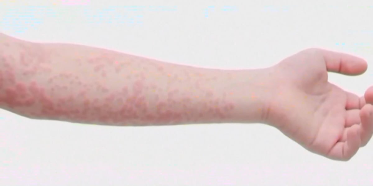 Measles outbreak grows in Southwest, 138 cases within two hours of Las Vegas