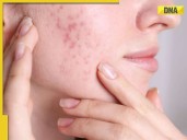 Acne during periods? Why pimples flare up and how to control them
