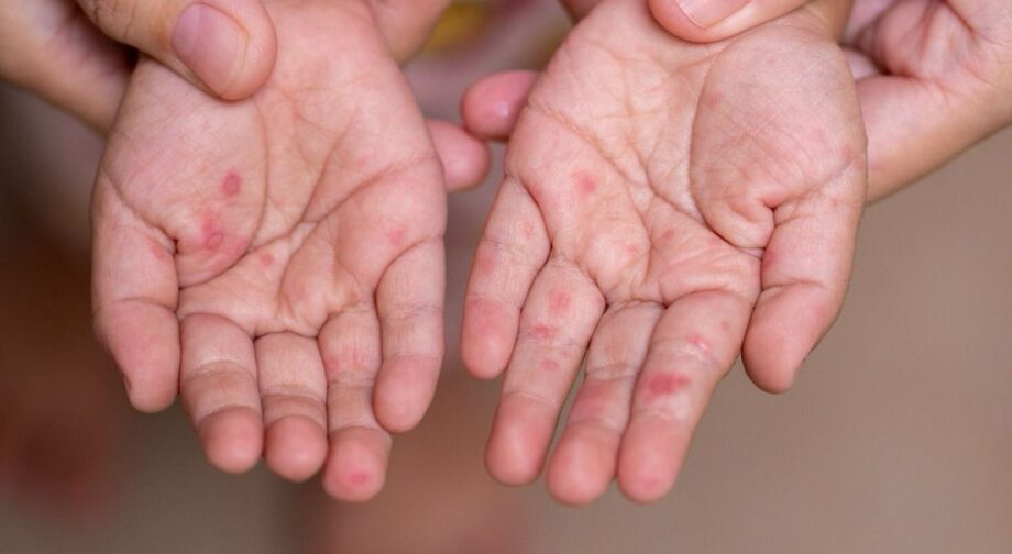 Reporta Salud 32 brotes activos de Coxsackie en Hidalgo