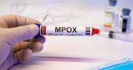 New, More Dangerous Mpox Strain Found in 3 Californians