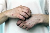 México rebasa los 5 mil casos de sarampión en este 2025