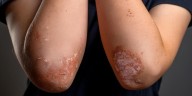 El divorcio y la separación podrían aumentar el riesgo de psoriasis en los niños
