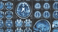 Identifican una enzima clave en la Atrofia Muscular Espinal, enfermedad rara hereditaria