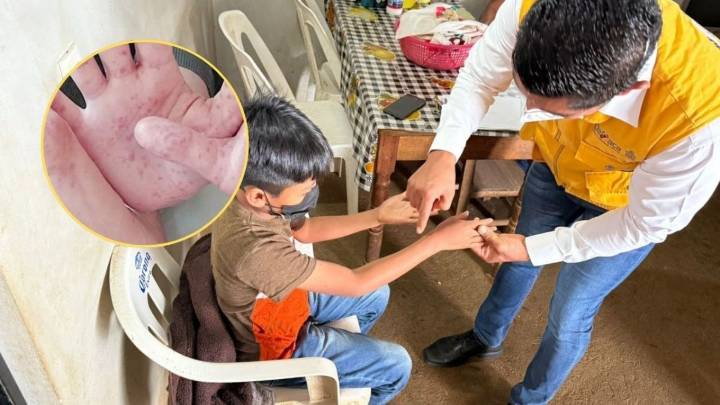 ¿Qué es el Coxsackie? El virus que ha causado 753 casos en menores de 5 años en Oaxaca