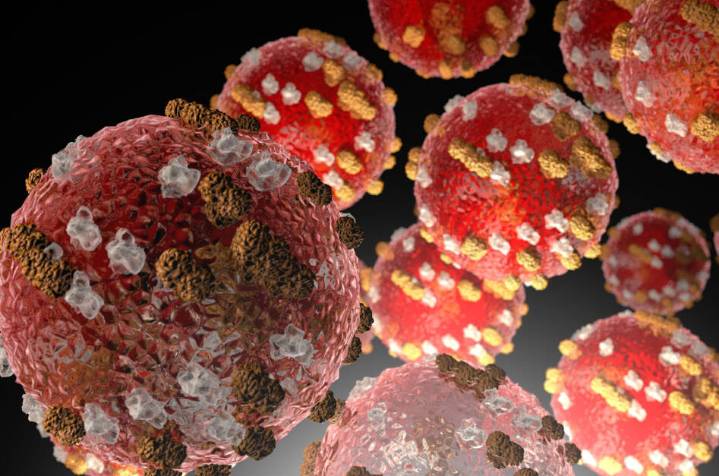 New measles case could have exposed people in Kent, Renton, Tukwila