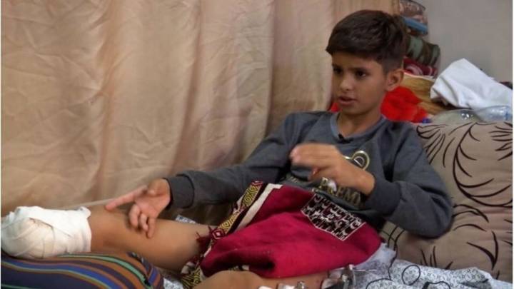 OMS: la guerra en Gaza ha causado 5.000 amputaciones