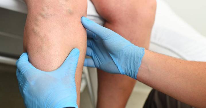 Escleroterapia: una opción segura y efectiva para tratar las várices y venas superficiales