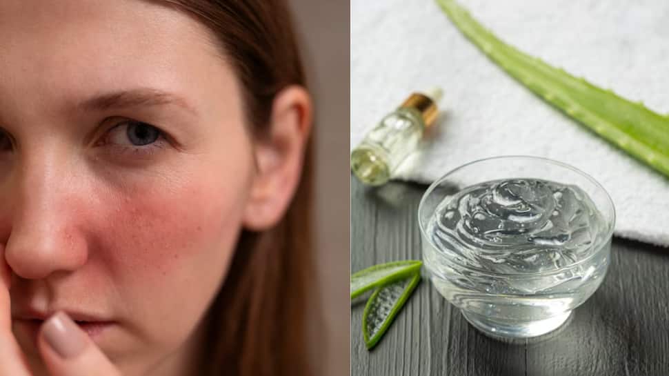 Aloe Vera Side Effects On Skin: Risks, Allergic Reactions, Irritations, And Who Should Avoid Using It