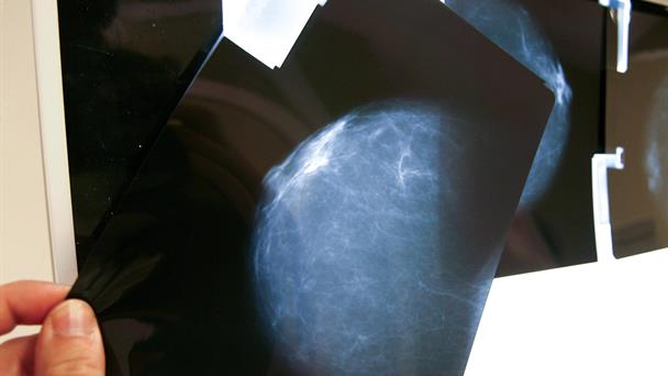 Expertos alertan sobre la falta de registros de cáncer de mama en América Latina