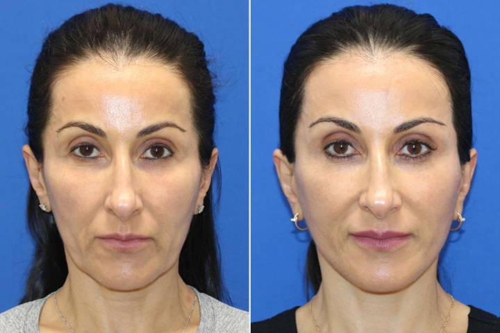 Woman, 53, Let Her Plastic Surgeon Husband Perform Her Facelift 