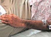 Van 88 casos de viruela símica en Antioquia. ¿Hay que encender las alarmas?