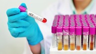 La hepatitis C ya es casi una enfermedad rara en España y podría erradicarse antes de 2030