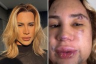 Procedimiento "foxy eyes". Un influencer brasileño de 31 años murió tras una cirugía estética que le hizo un dentista