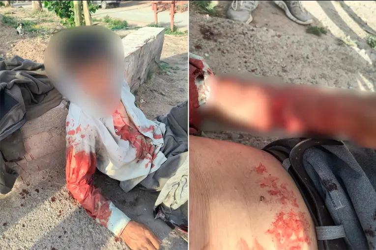 Dos pitbull atacaron a un hombre de 75 años y le provocaron graves heridas