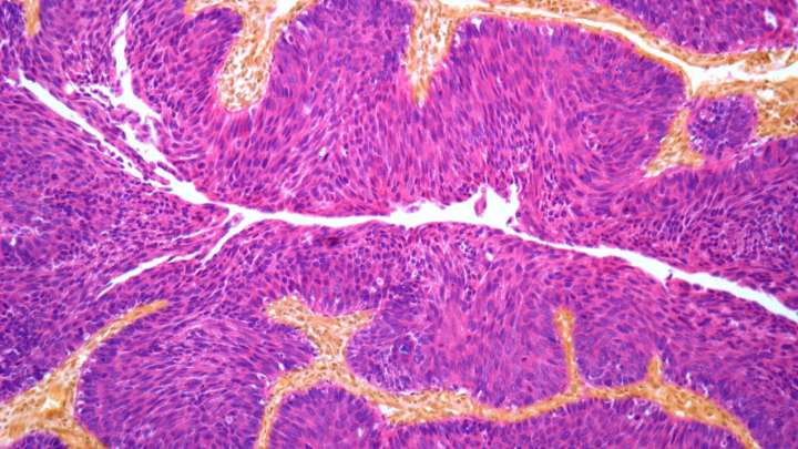 ESMO 2025: ctDNA blood test could change how cancer is treated