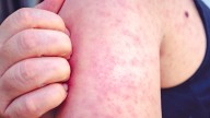 Premature baby dies of measles; Alberta’s first measles death in 2025