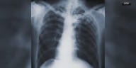 Christian County Health Department confirms case of tuberculosis