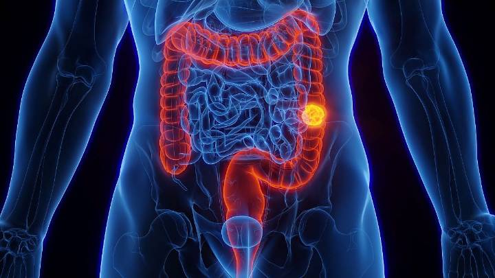 Bleeding Tied To Colon Cancer Risk Among Young Adults