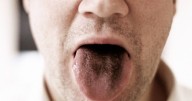 Diet change can fix 'black hairy tongue' condition