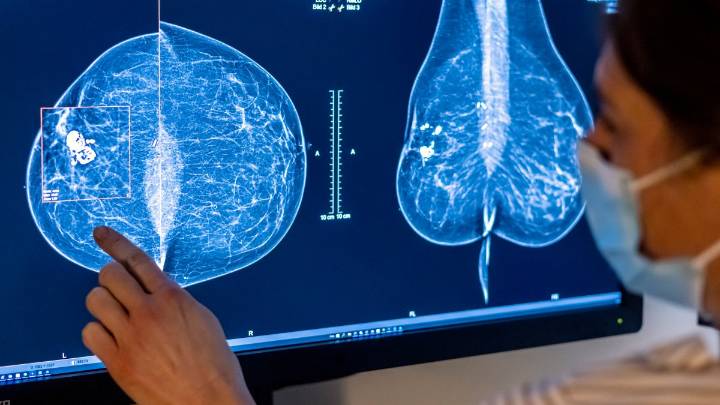 Exclusive: ‘Revolutionary' AI-powered mammograms can predict breast cancer risk