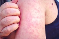 More Texas kindergarteners are coming to school without measles vaccination proof or exemptions