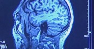 Seeking participants for study of medication to slow onset of Alzheimer's
