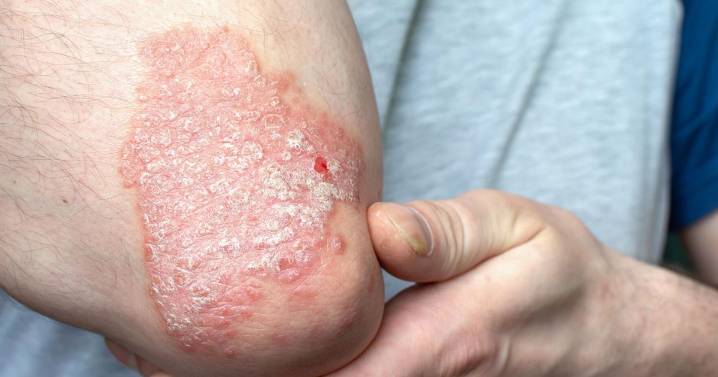 ¿Qué es la psoriasis y por qué va más allá de la piel?