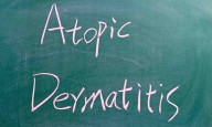 FDA Approves Zoryve Cream for Young Children with Atopic Dermatitis