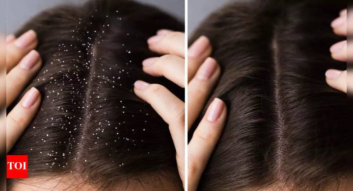 How to get rid of oily and sticky dandruff: 10 tips for a healthy scalp