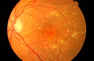 Un implante ocular restaura la visión central en pacientes con daños en la retina