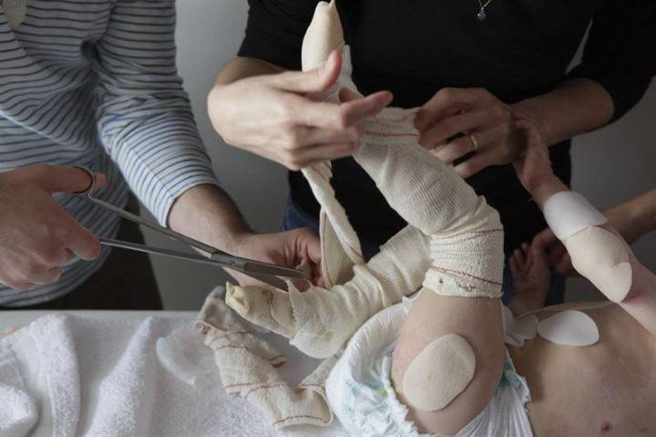 La terapia génica para Piel de Mariposa aún no está disponible en España