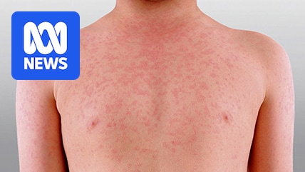 Measles warning in WA's Pilbara as confirmed cases rise