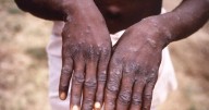Mpox symptoms explained as warning issued over 'global spread' of infection